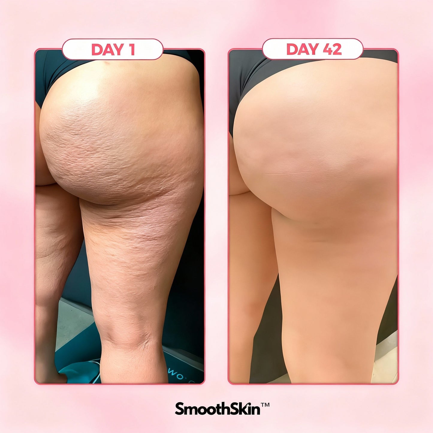 SmoothSkin™ Cellulite Solution