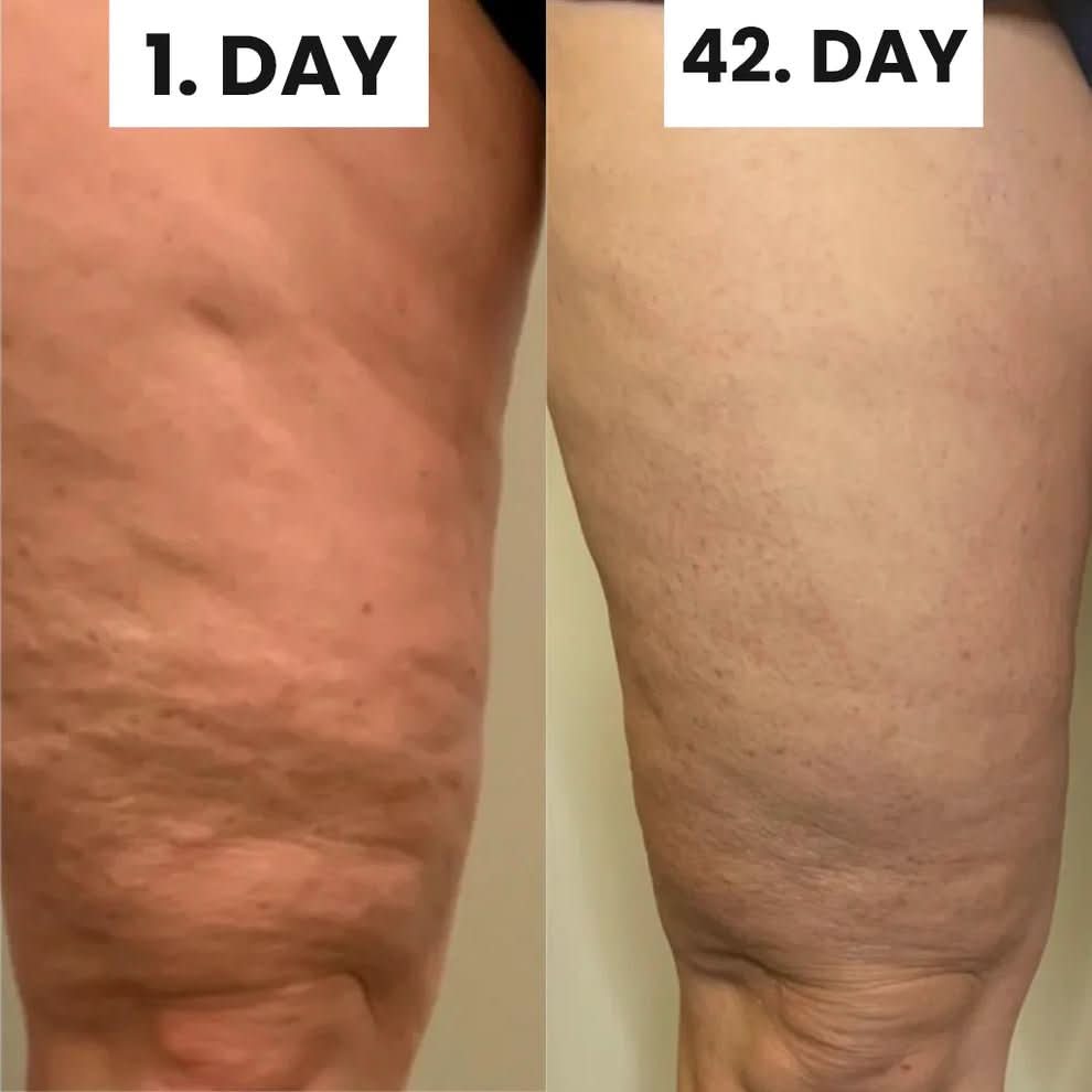 SmoothSkin™ Cellulite Solution